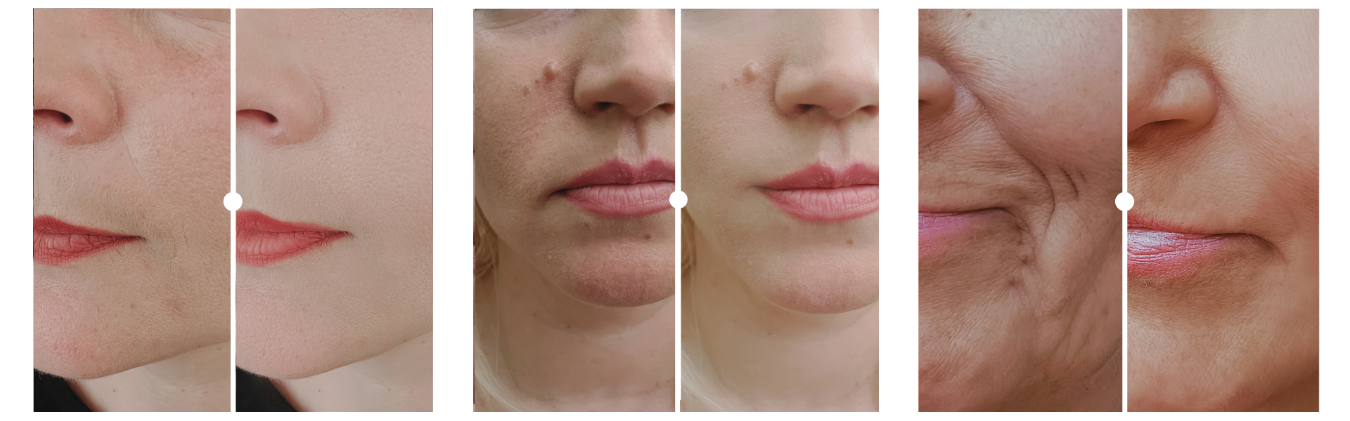 Résultats avant/après d’un soin fermeté – ovale du visage redessiné naturellement